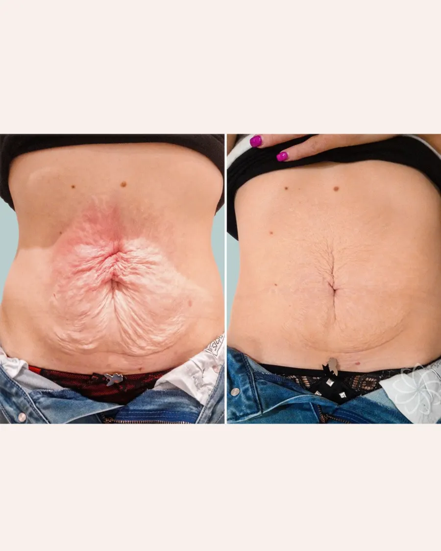 Skin Tightening at Cinch Clinics